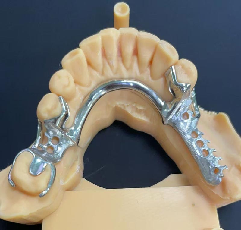 Koobalt-kroomi raamistiku (Co Cr Framework) eelised