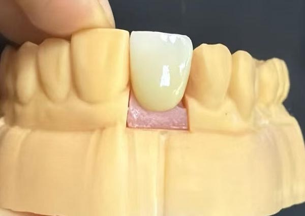 Hammastevahesid saab parandada – sirged hambad on kõige atraktiivsemad!