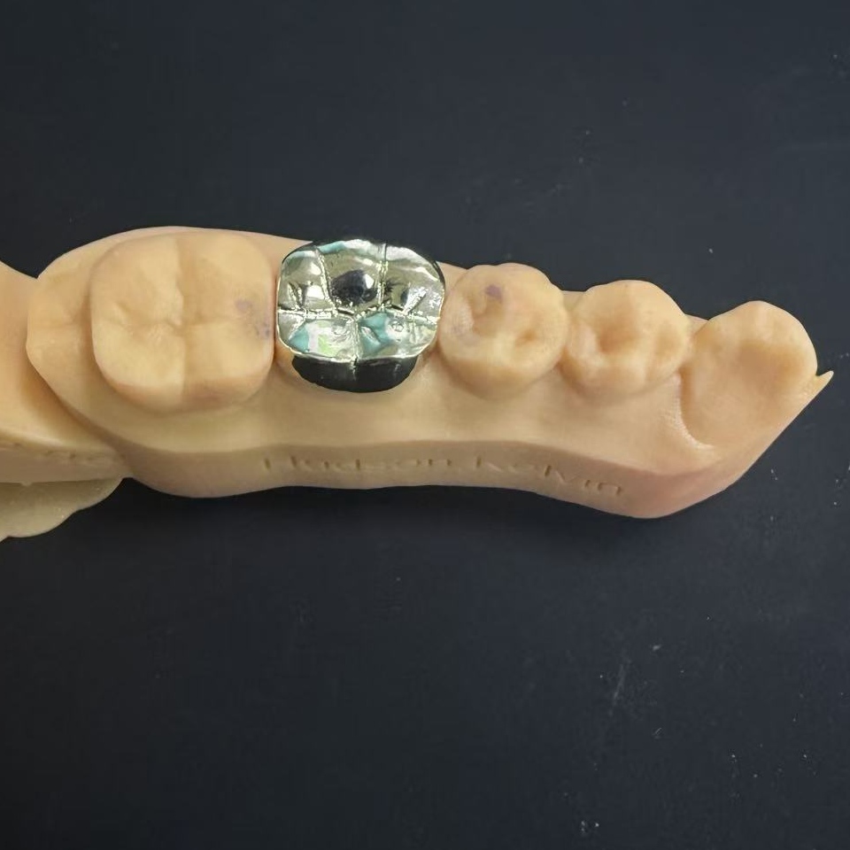 Kuldkroonid: väärismetallide valik eluaegseks hammaste taastamiseks