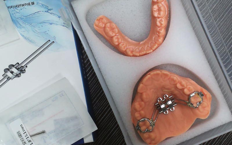 Mõistke MSE skeleti laienemist WM Dental Labiga